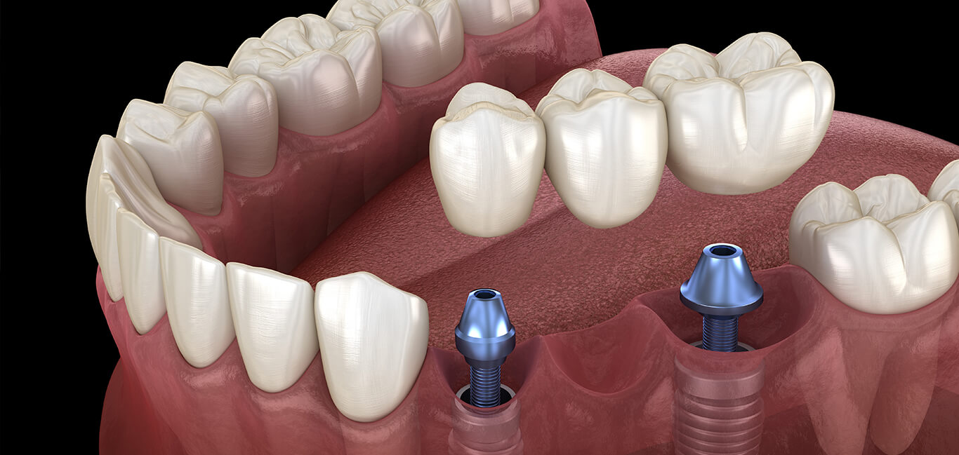 Can Dental Implants Get Stained in Coconut Creek? - Informed Explorer